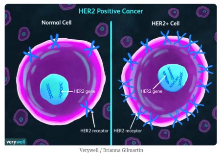 proteina HER2 pozitiv - cancer san